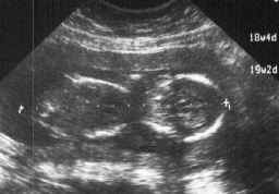 fetus-01-09-98.jpg (70649 bytes)