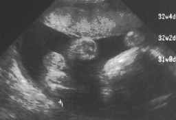 fetus-24-11-98.jpg (73908 bytes)
