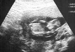 fetus-27-07-98.jpg (41339 bytes)